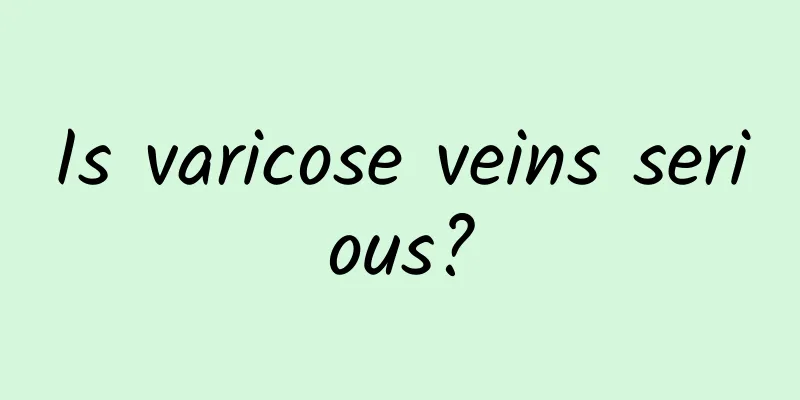 Is varicose veins serious?