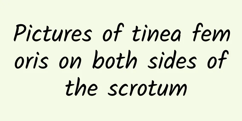 Pictures of tinea femoris on both sides of the scrotum