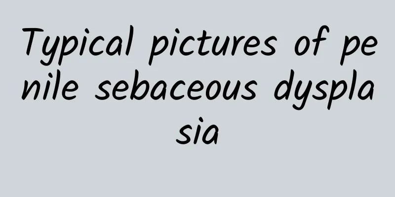 Typical pictures of penile sebaceous dysplasia