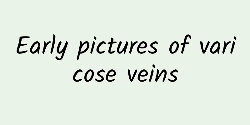 Early pictures of varicose veins