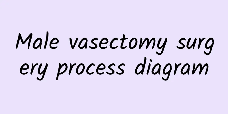 Male vasectomy surgery process diagram
