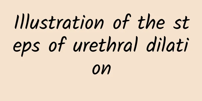 Illustration of the steps of urethral dilation