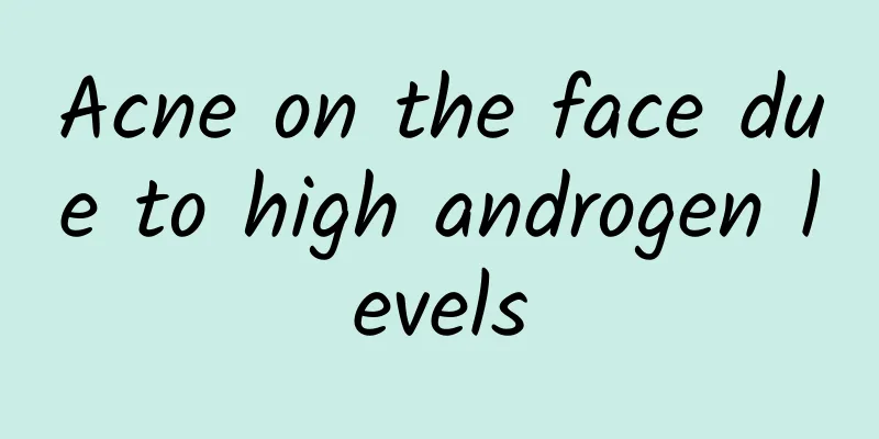 Acne on the face due to high androgen levels