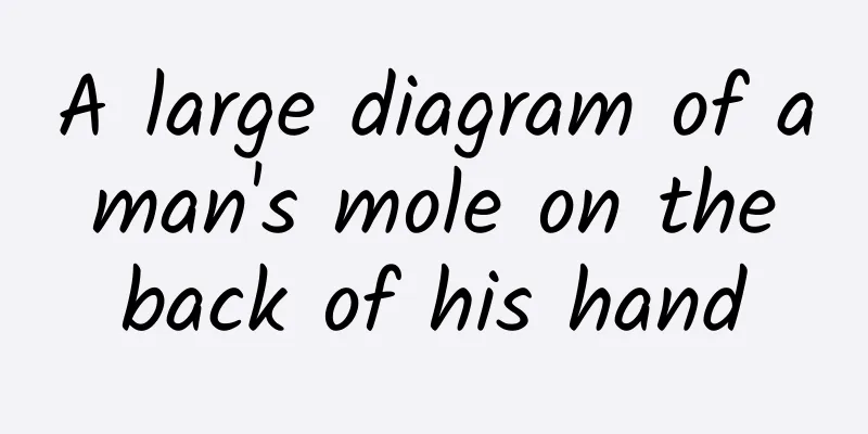 A large diagram of a man's mole on the back of his hand