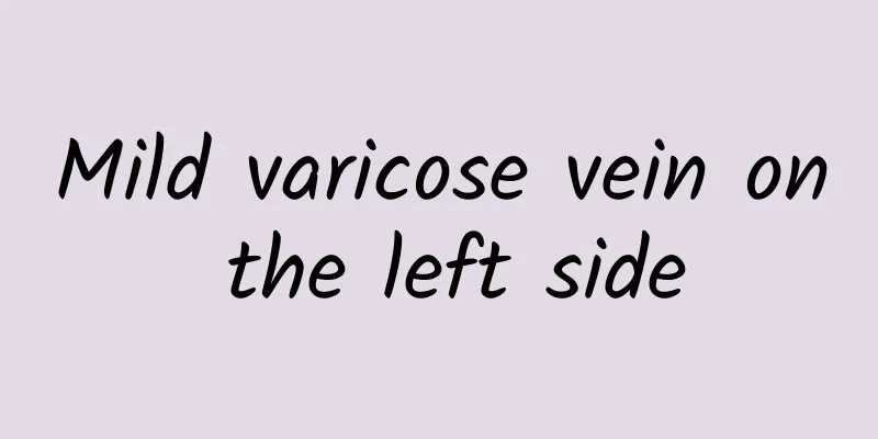 Mild varicose vein on the left side