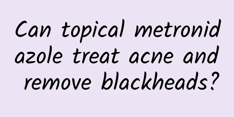 Can topical metronidazole treat acne and remove blackheads?